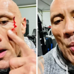 The Rock bleeds after suffering face injury