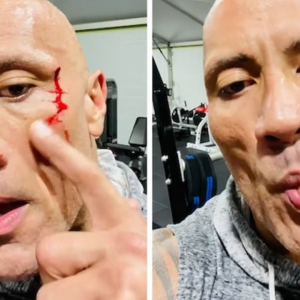 The Rock bleeds after suffering face injury