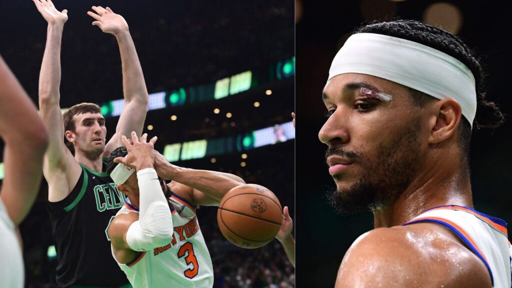 Luke Kornet collides with Josh Hart (L); Josh Hart stitches (R)